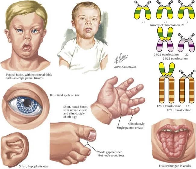 Medical illustration plate of physical traits associated with Down Syndrome, alongside diagrams of trisomy 21 and chromosome translocations.